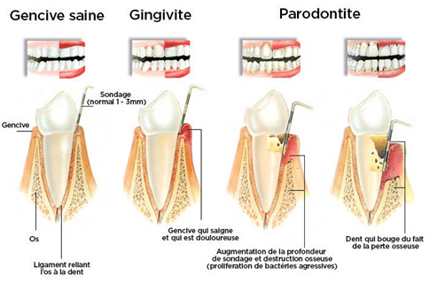 La maladie parodontale